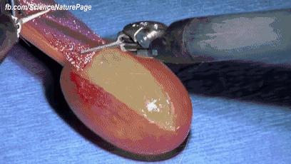 邵逸夫医生排名,邵逸夫甲状腺手术怎么样