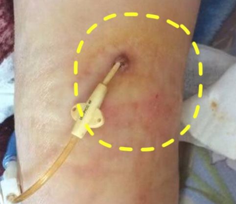 穿刺点感染怎么办?两种方法任你选