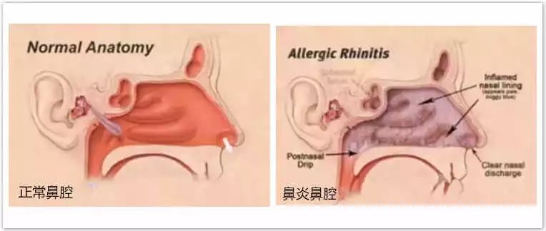 鼻子不通气鼻塞怎样快速好起来,鼻塞通鼻窍中成药