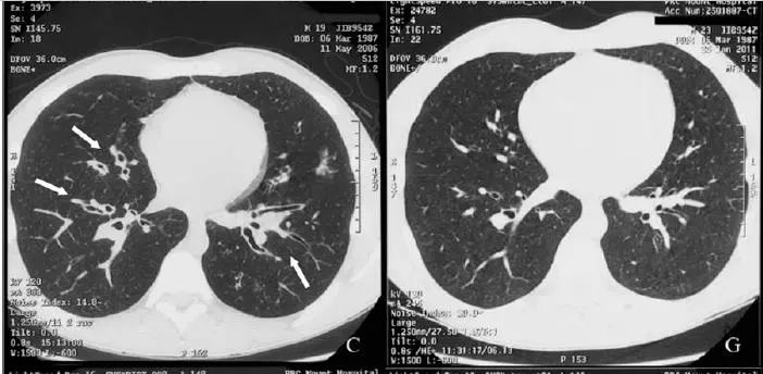 支气管扩张能治好吗要怎么治,支气管扩张能治好吗如何治疗
