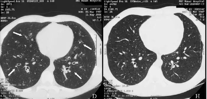 支气管扩张能治好吗要怎么治,支气管扩张能治好吗如何治疗