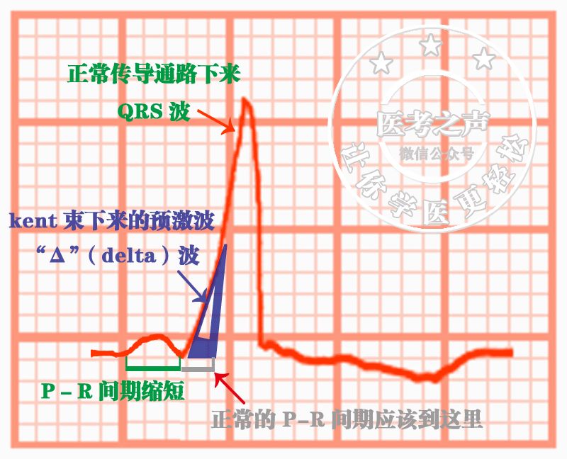 心电图秒懂,心电图零基础都秒懂