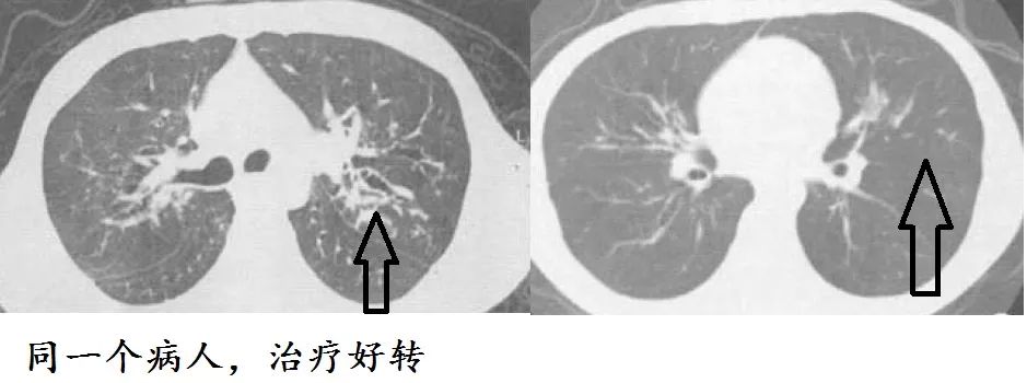 支气管扩张能治好吗要怎么治,支气管扩张能治好吗如何治疗