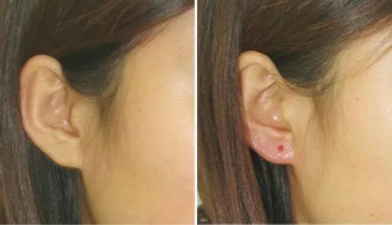 打耳洞的顾虑,打耳洞有顾虑