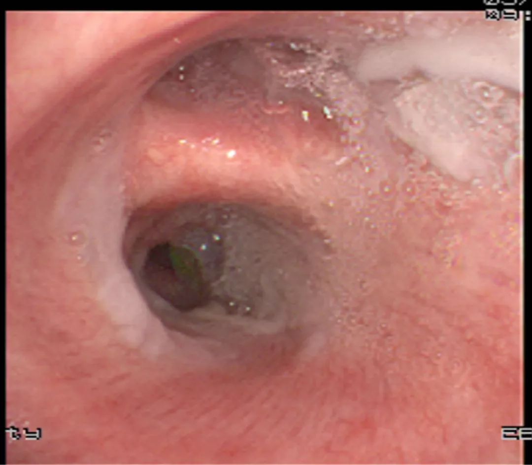 嗜酸性粒细胞支气管炎可以跑步吗,嗜酸性粒细胞支气管炎锻炼方法