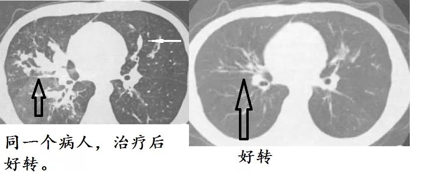 支气管扩张能治好吗要怎么治,支气管扩张能治好吗如何治疗