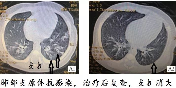 支气管扩张能治好吗要怎么治,支气管扩张能治好吗如何治疗