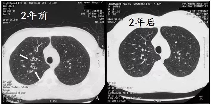 支气管扩张能治好吗要怎么治,支气管扩张能治好吗如何治疗