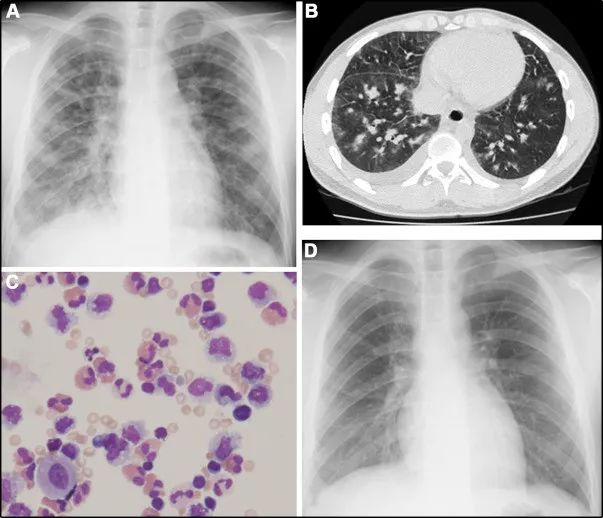 嗜酸性粒细胞支气管炎可以跑步吗,嗜酸性粒细胞支气管炎锻炼方法