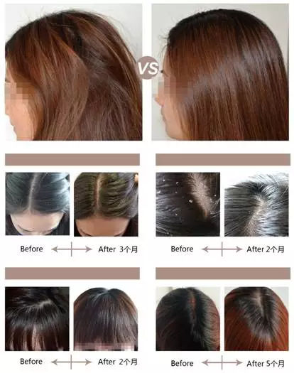 头顶头发稀疏毛囊是否坏死,因为脱发怎么知道毛囊有没有坏死