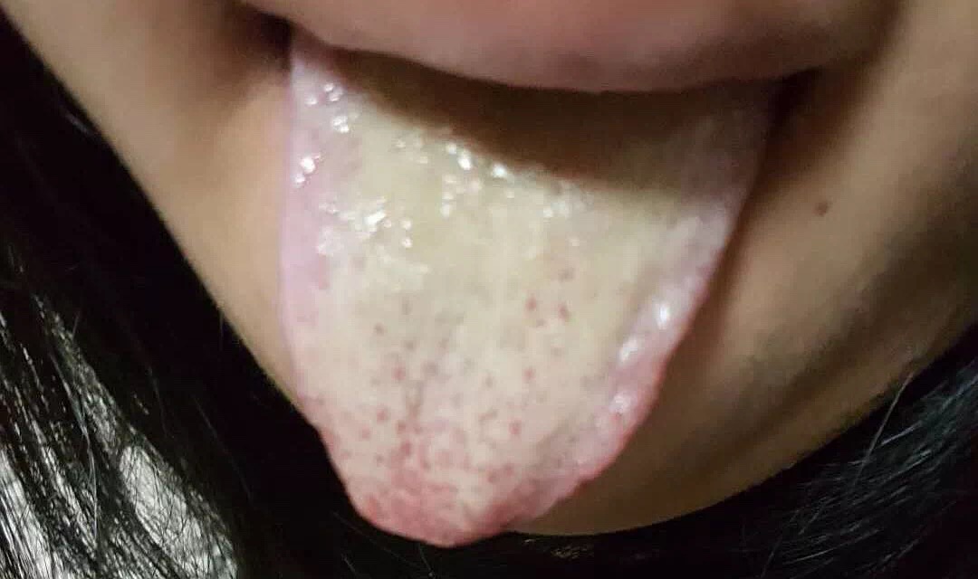 根据舌苔辨别身体情况,舌苔白厚什么原因吃什么中成药