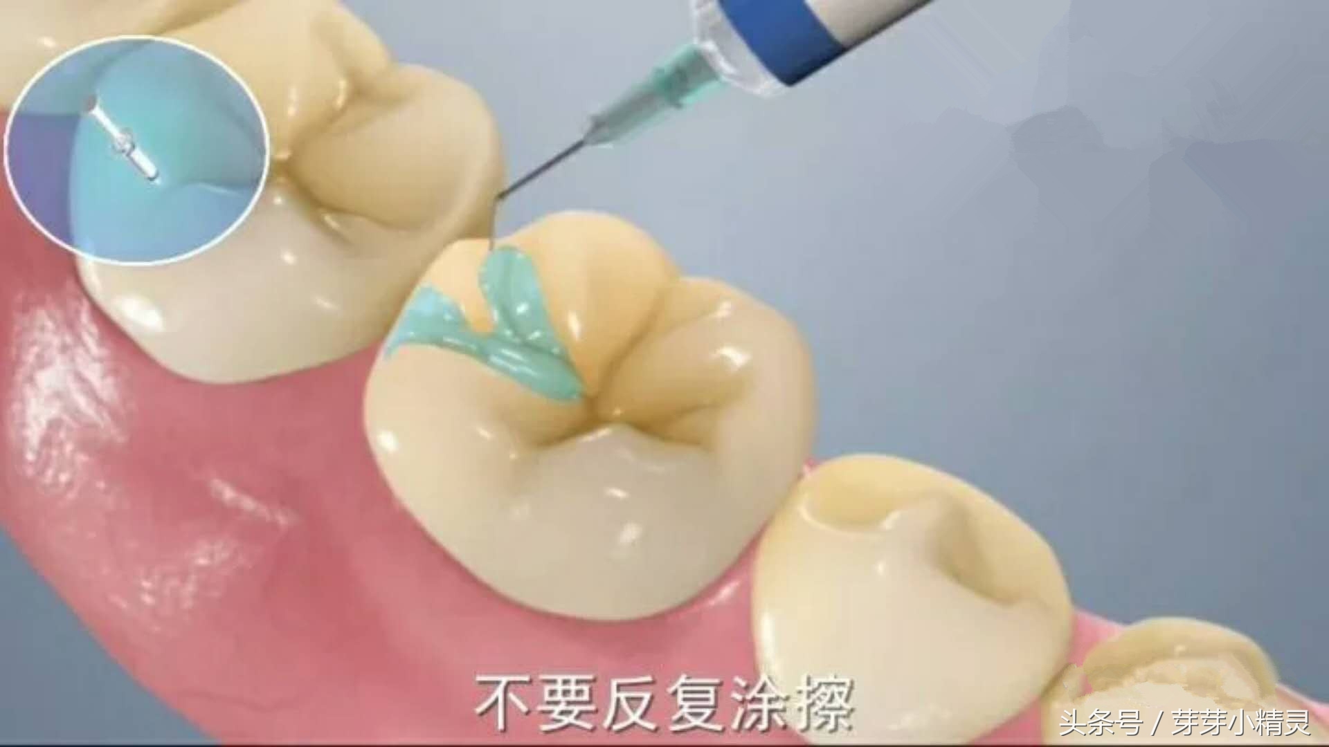 窝沟封闭注意事项,虫牙可以做窝沟封闭吗