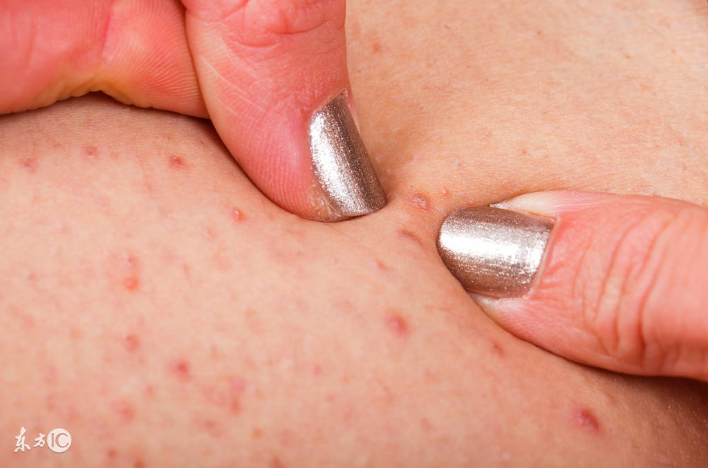 穿凿性毛囊炎最新治疗方法,头上毛囊炎治疗最快方法白醋