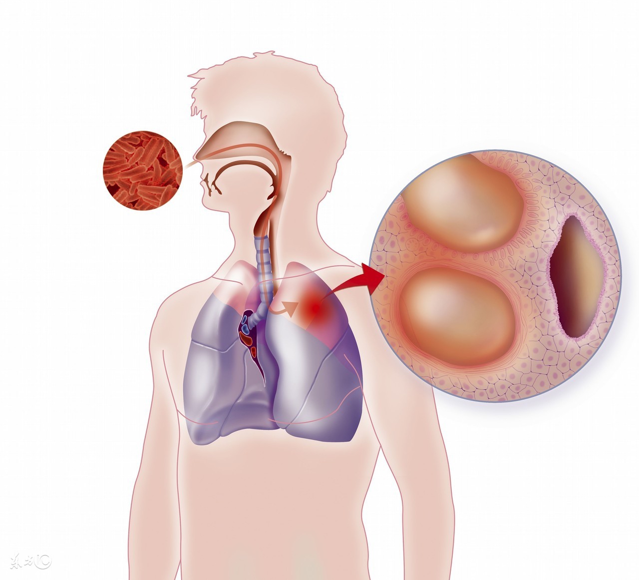 治疗肺结核过程中要注意什么,肺结核在治疗中又严重了怎么回事