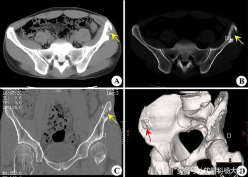 这个15年前就发现的腰部小鹌鹑蛋,让80岁老先生吃了苦头