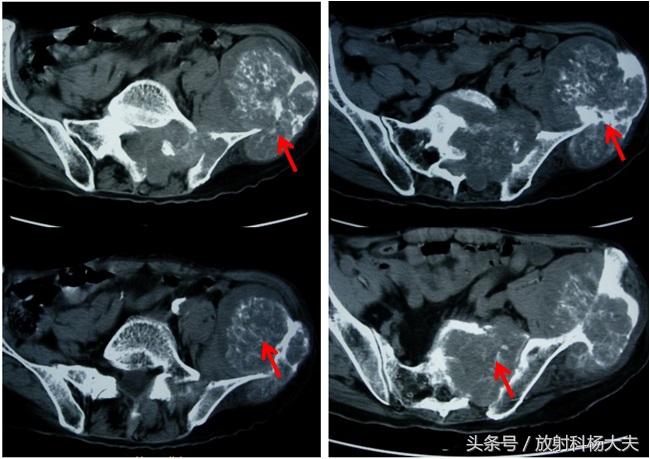 这个15年前就发现的腰部小鹌鹑蛋,让80岁老先生吃了苦头