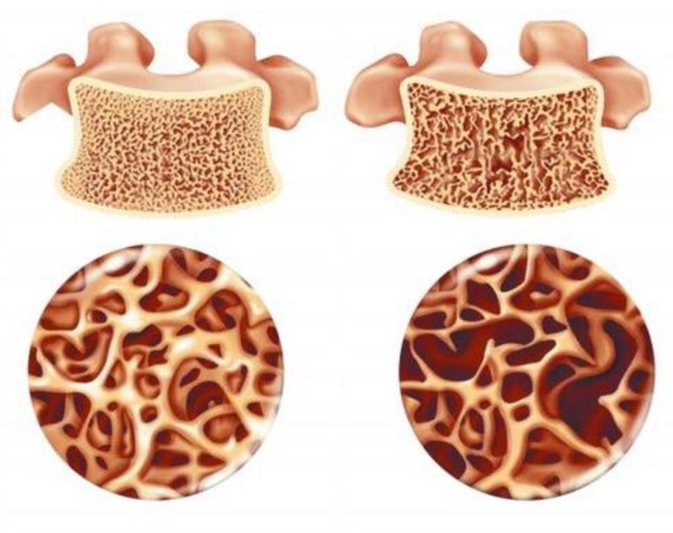 骨密度结果能确诊有无骨质疏松吗,年轻人骨质疏松骨密度还能增强吗