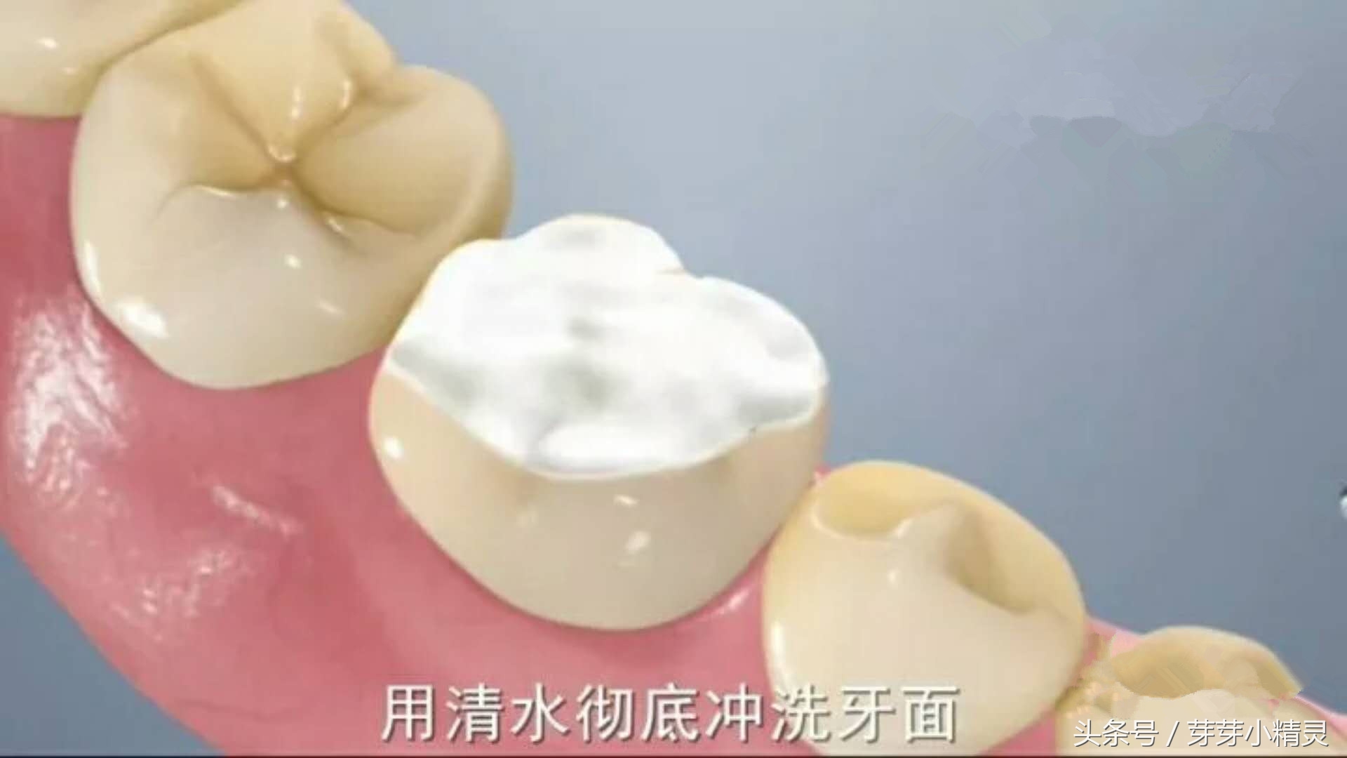 窝沟封闭注意事项,虫牙可以做窝沟封闭吗