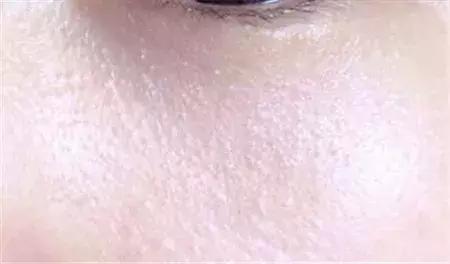 20岁应该用什么样的眼霜,为什么过了20岁一定要用眼霜