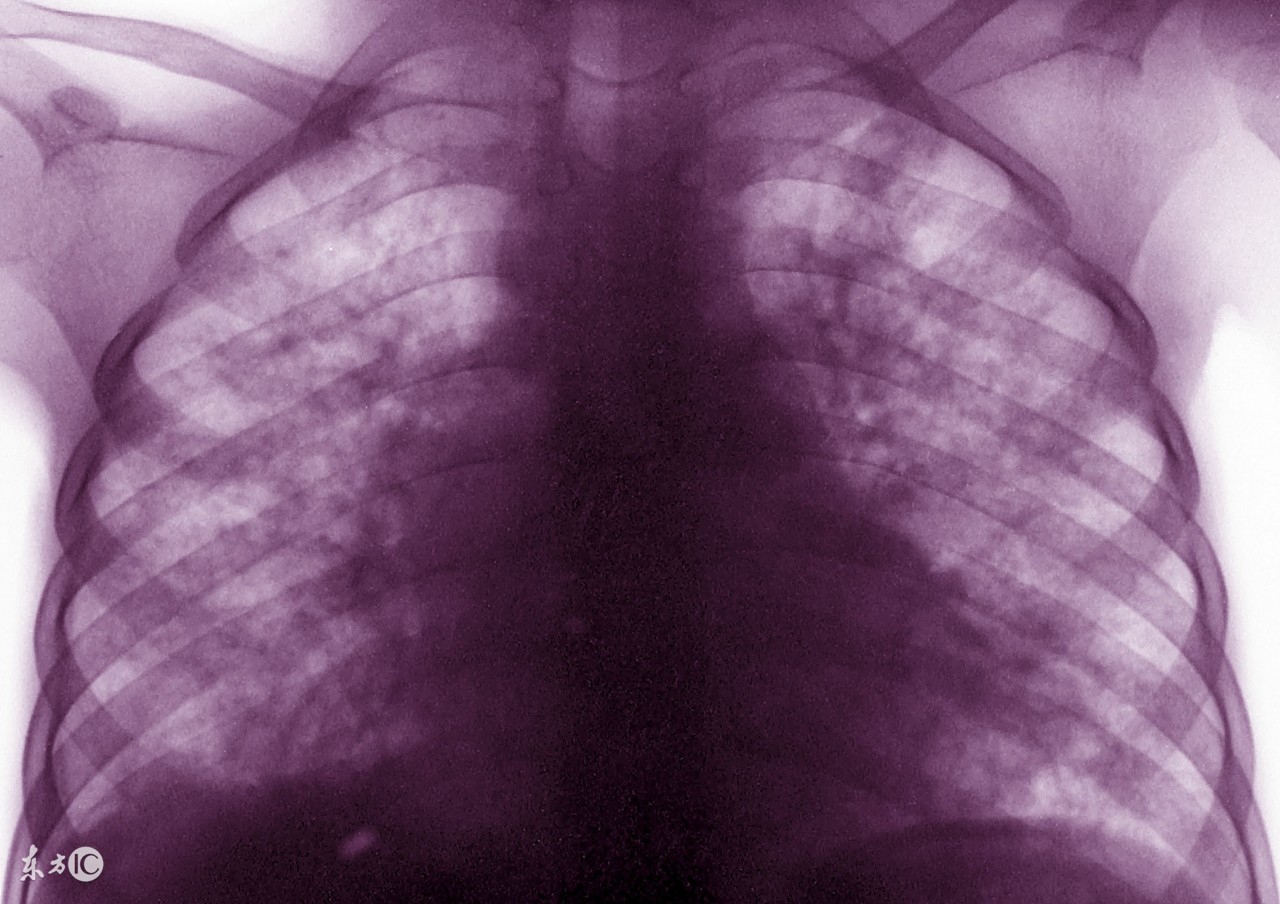 肺结核用中医好还是西医好,中医是怎么治疗肺结核的