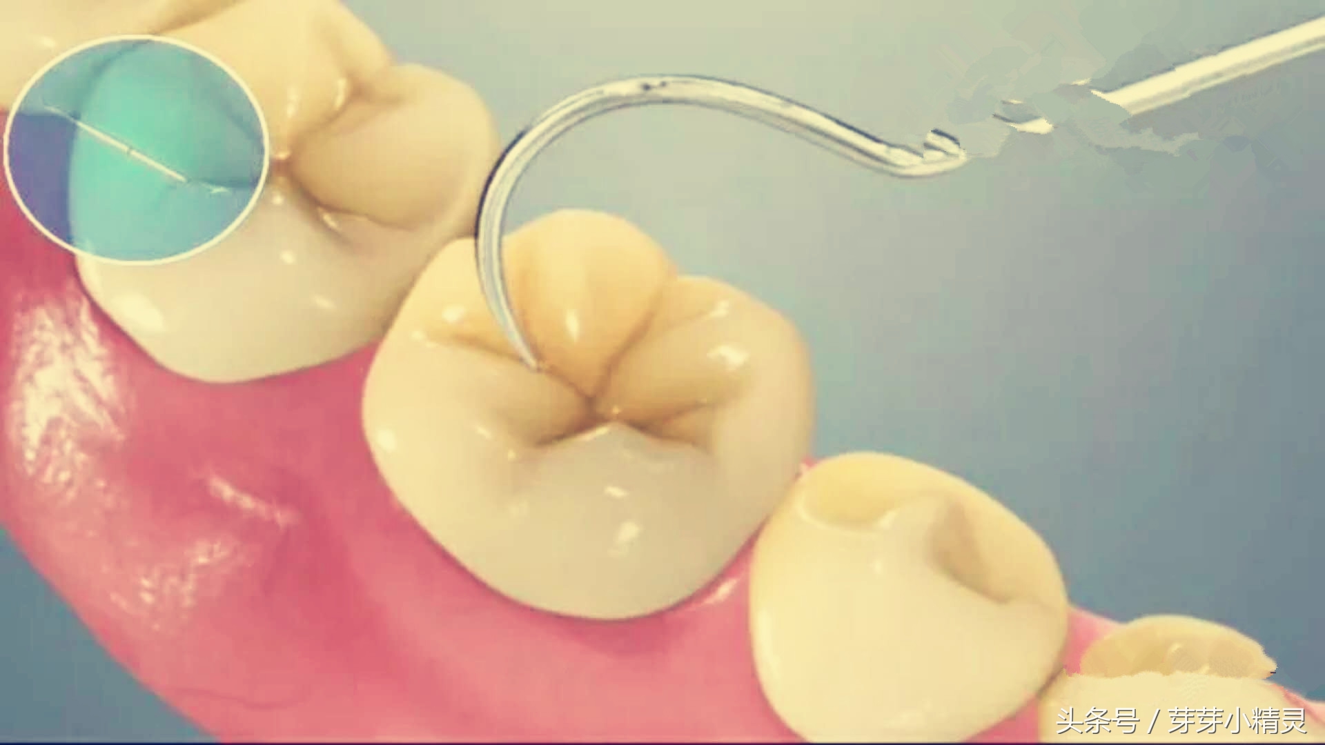 窝沟封闭注意事项,虫牙可以做窝沟封闭吗