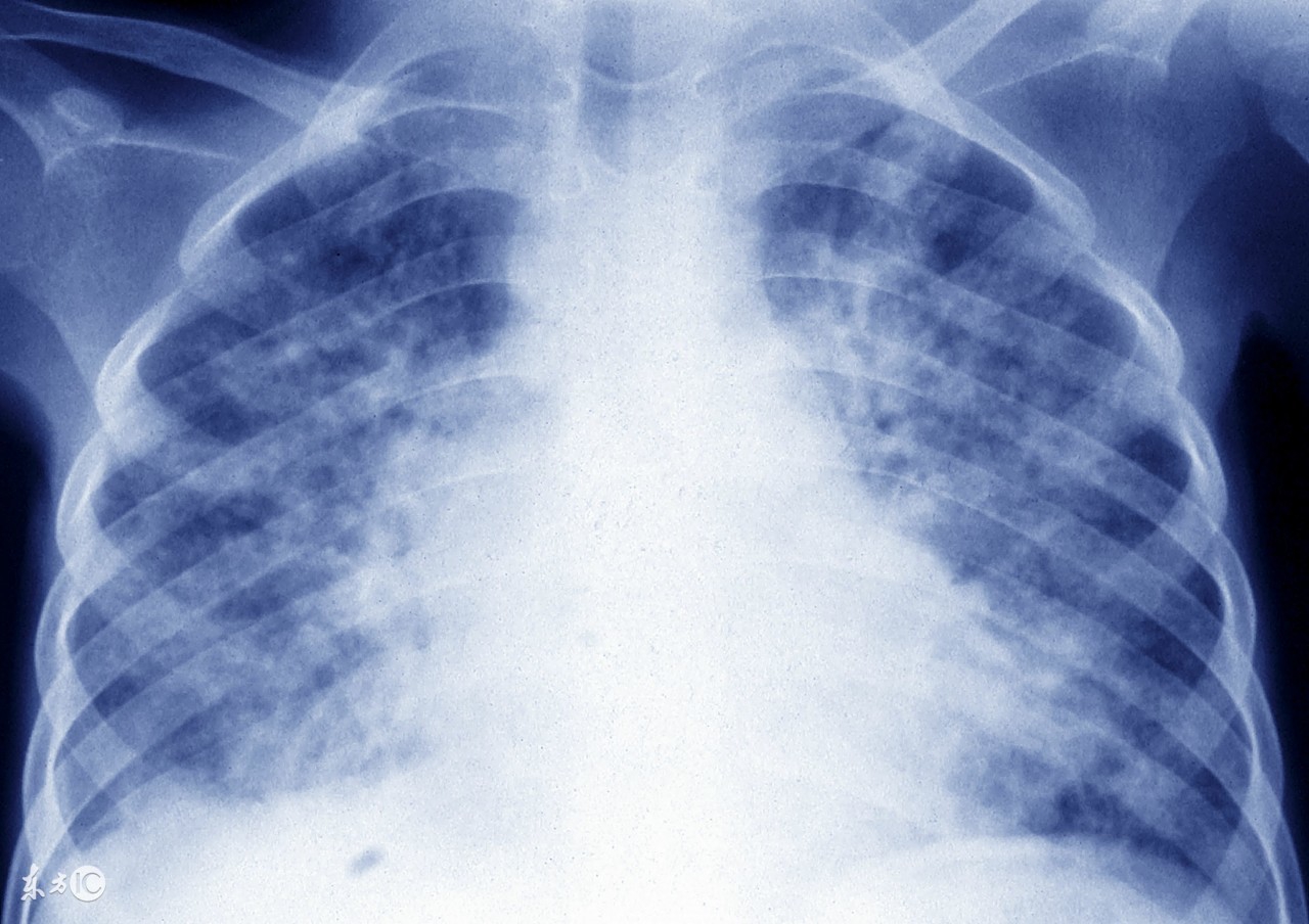 治疗肺结核过程中要注意什么,肺结核在治疗中又严重了怎么回事