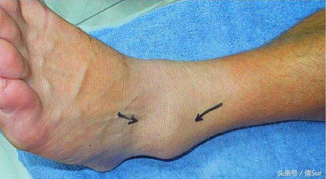 怎么避免脚踝习惯性扭伤,儿童脚踝反复扭伤