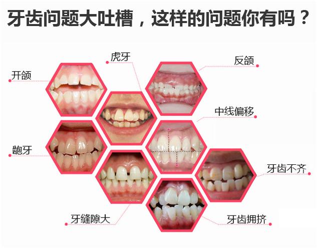 隐形矫正免费试戴，《芳华》女主也来打Call