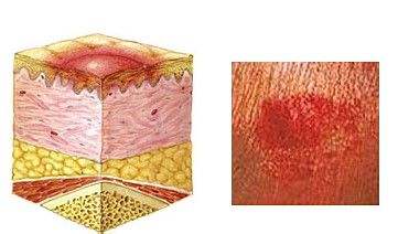 17年的疤痕长了脓包怎么治,17年的腰痛怎么办