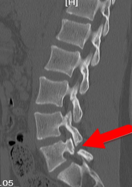 峡部裂如何锻炼,峡部裂原因