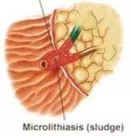 慢性胰腺炎胰管结石怎么保守治疗,慢性胰腺炎胰管结石手术成功率
