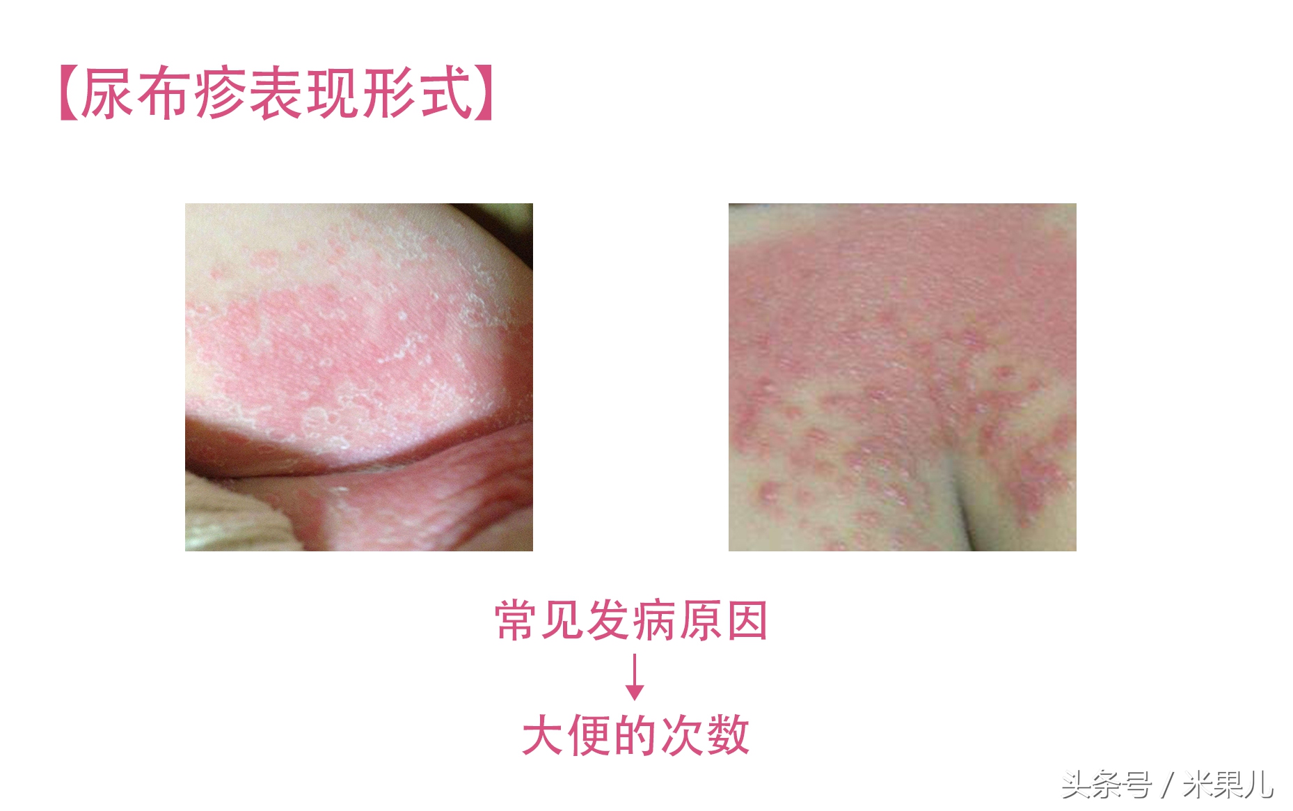 宝宝过敏怎么办新手爸妈秘籍,妈妈过敏体质宝宝怎么办