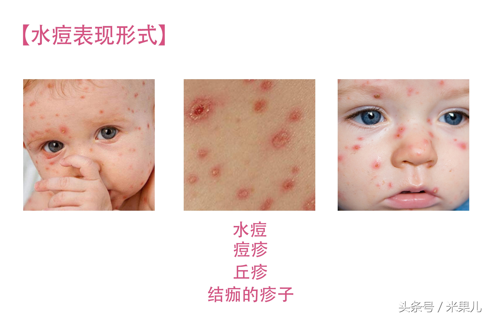 宝宝过敏怎么办新手爸妈秘籍,妈妈过敏体质宝宝怎么办