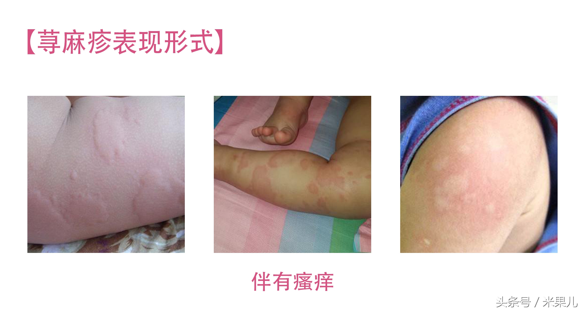 宝宝过敏怎么办新手爸妈秘籍,妈妈过敏体质宝宝怎么办