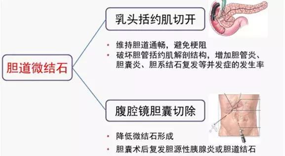 慢性胰腺炎胰管结石怎么保守治疗,慢性胰腺炎胰管结石手术成功率