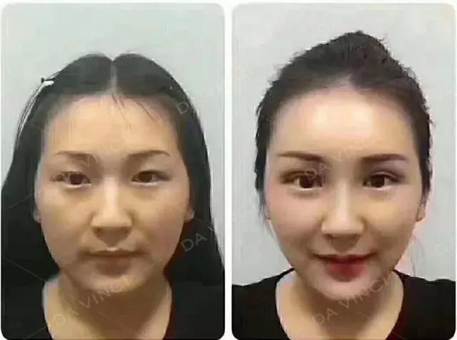 做完线雕真的会年轻吗,经常做线雕面部会年轻吗