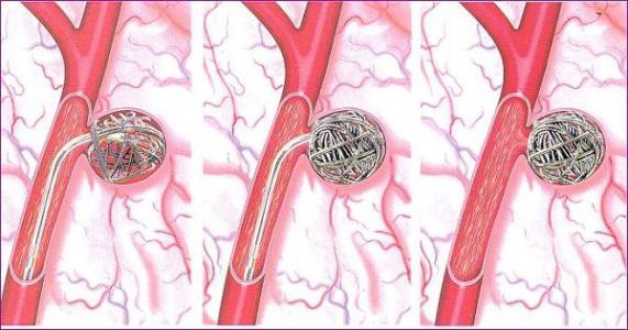 脑血管畸形立体定位治疗,脑血管爆破有救吗