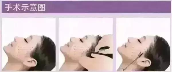 做完线雕真的会年轻吗,经常做线雕面部会年轻吗