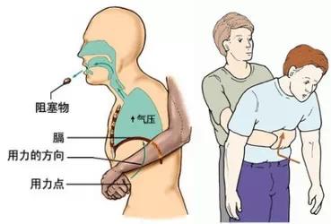 海姆立克急救法儿童救妈妈,海姆立克急救法救女士