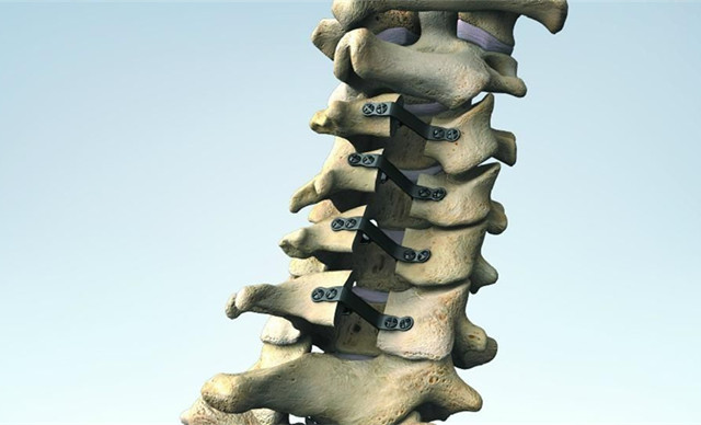 困扰多年的颈椎病终于有所改善,多年的颈椎病终于好了