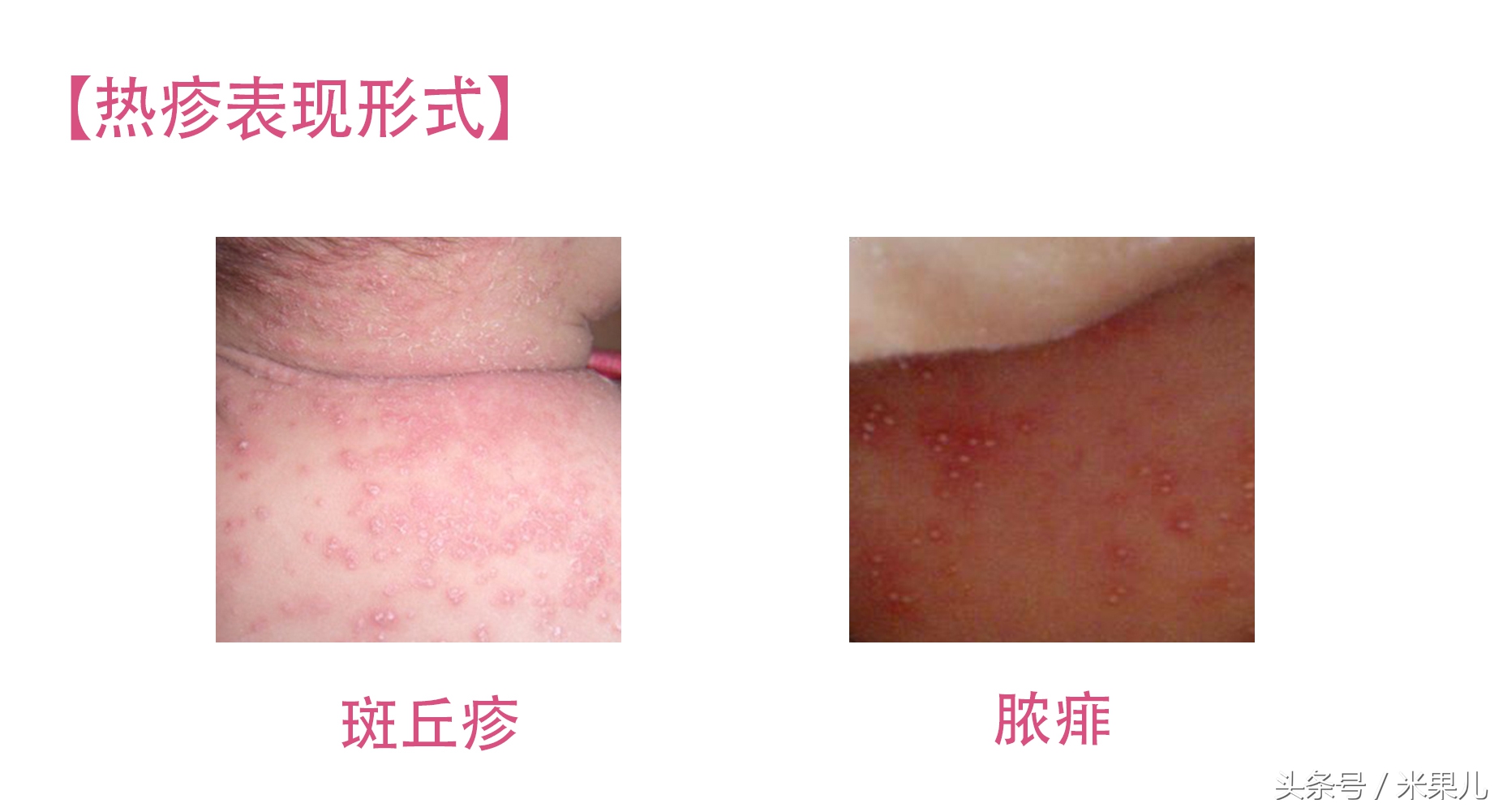 宝宝过敏怎么办新手爸妈秘籍,妈妈过敏体质宝宝怎么办