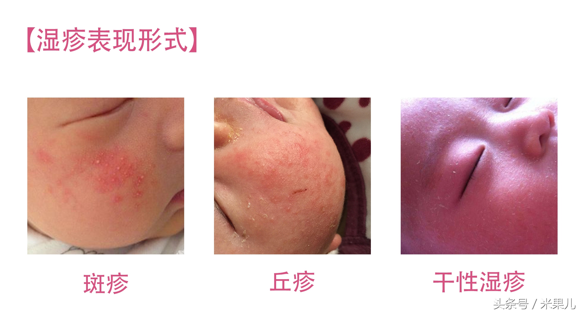 宝宝过敏怎么办新手爸妈秘籍,妈妈过敏体质宝宝怎么办