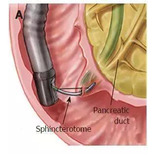 慢性胰腺炎胰管结石怎么保守治疗,慢性胰腺炎胰管结石手术成功率