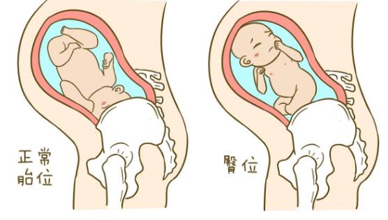 胎儿打嗝孕妈需要做什么,胎儿打嗝孕妈需要什么姿势