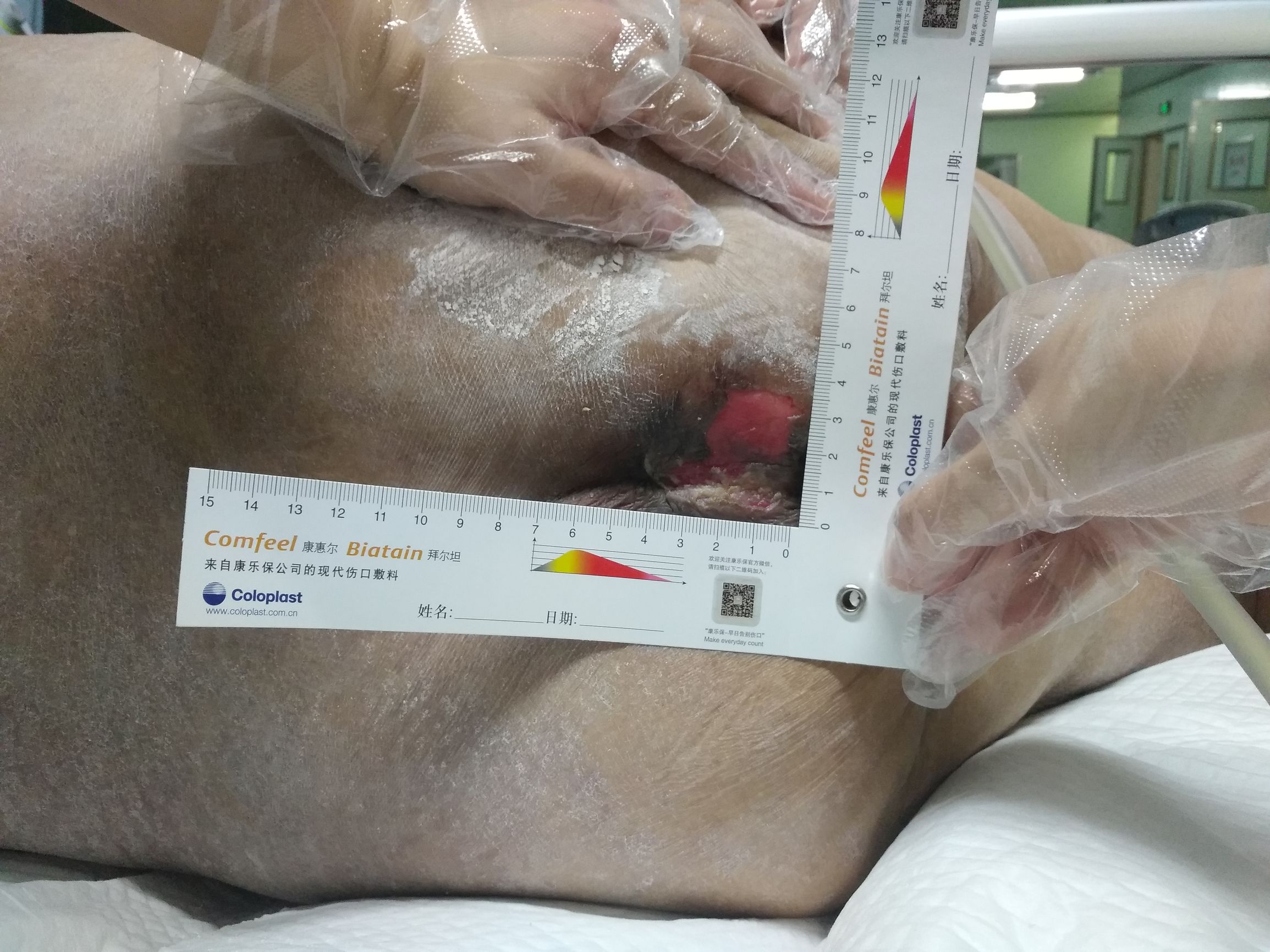 医生怎么治疗压疮,医院里压疮有没有好办法