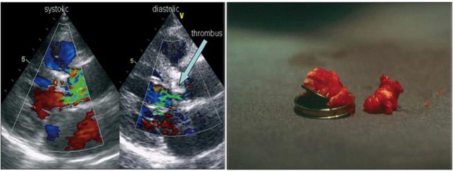 换了心脏瓣膜的人怀孕风险有多高,瓣膜置换术后为什么难怀孕