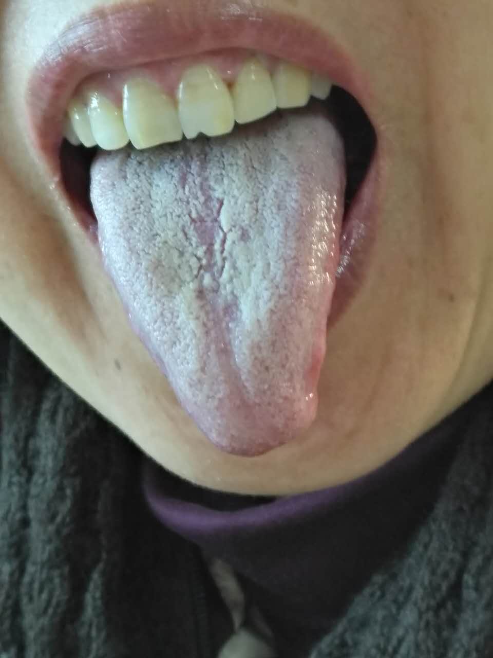 乙肝大三阳抗病毒治疗费用,我的乙肝小三阳自愈了