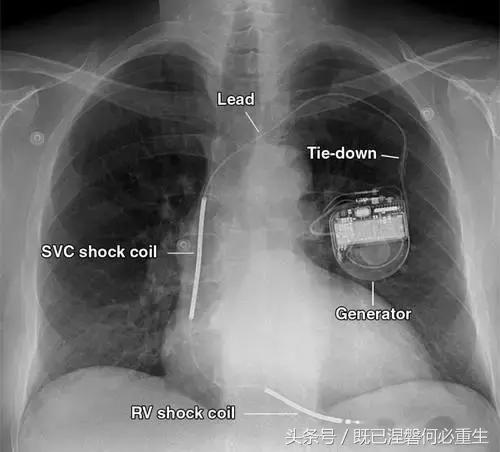 心内除颤仪和起搏器有什么区别,起搏器除颤仪