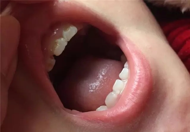 如何预防奶瓶龋？宝宝奶瓶龋了怎么办