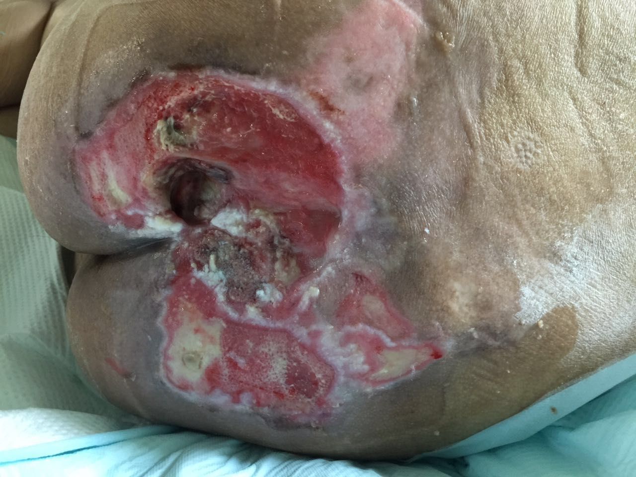 医生怎么治疗压疮,医院里压疮有没有好办法